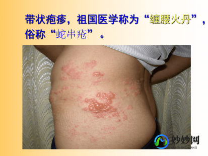 缠腰龙疱疹怎么治疗,蛇缠腰带状疱疹怎么治疗