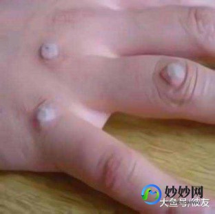 手上长瘊子怎么去除,手上长了瘊子怎么去掉
