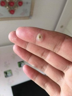 手上长瘊子怎么去除,手上长了瘊子怎么去掉