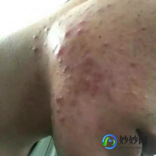 茎体长痘痘,上长了好多痘痘