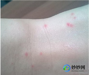 身上起小红点不痒,身上无缘无故起小红点不痛不痒