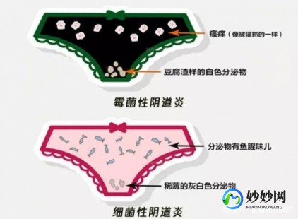 白带发黄有异味,白带黄臭