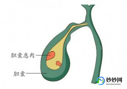 胆囊息肉原因,为什么会有胆囊息肉