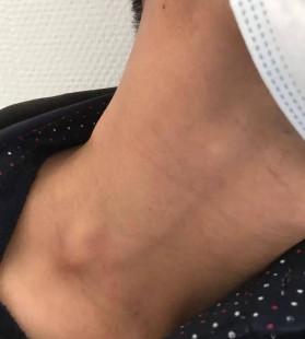 颈部肿块,脖子上有肿块是怎么回事