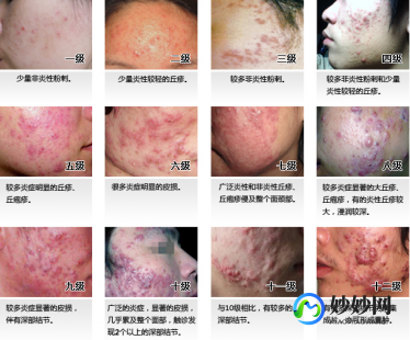 青春痘痤疮怎么治疗,痤疮型痘痘怎么消除