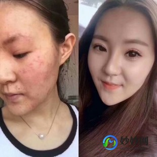 脸蛋红血丝,脸颊发红有红血丝怎么办