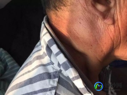 耳朵旁边长了一个硬疙瘩是怎么回事,耳旁边有个硬块是什么