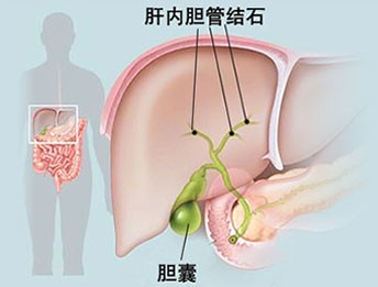 肝内胆管结石的饮食,肝上有结石要注意什么