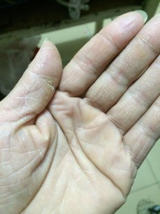 手部皮肤干裂,手指皮肤干燥开裂