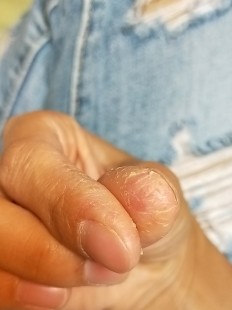 手部皮肤干裂,手指皮肤干燥开裂