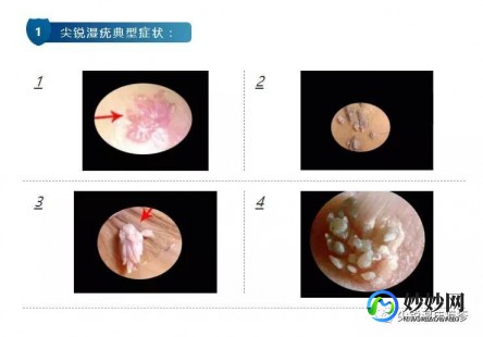 湿疣是怎么引起的,尖锐湿疣怎么得的