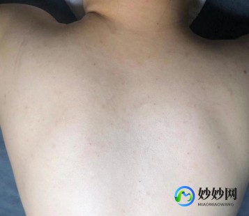 脖子里长疙瘩,脖子上长了一个疙瘩是怎么回事