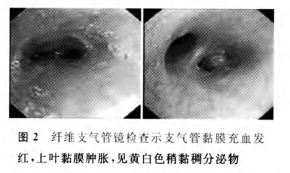 阳了怎么判断肺部是否感染,如果阳性会有什么感觉