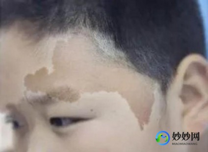 牛奶咖啡斑,牛奶斑是什么病