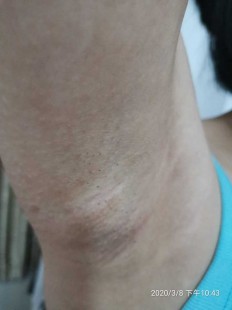 腋下看病挂什么科室,腋下挂什么科