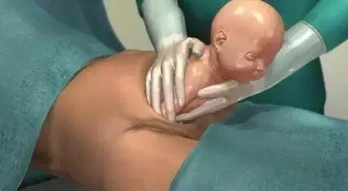 腹膜外剖宫产术与普通剖腹产区别,腹膜外剖宫产术与普通剖腹产区别