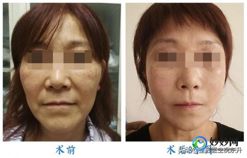 皮肤下垂怎么办,皮肤严重松弛下垂怎么办