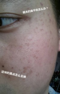 眼部扁平疣,眼部长扁平疣怎么去除