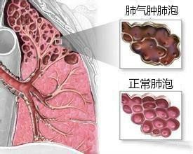 肺气泡是怎么回事严重吗,肺气泡是什么病严重吗