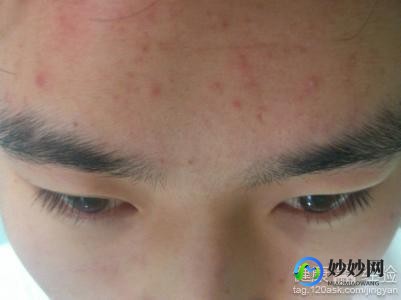 额头起痘痘怎么办,脸上额头长痘痘怎么消除