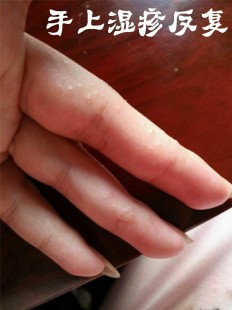 手上湿疹,手上经常起湿疹是什么原因