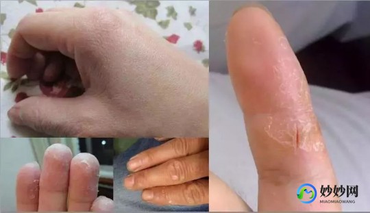 手上脱皮,手皮肤脱皮
