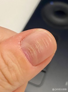 指甲上有横纹,指甲上有横纹是怎么回事