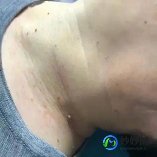 脖子上长的小肉粒,脖子上长了一个小肉粒是怎么回事