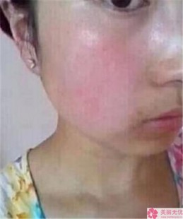 面部发红型红血丝,脸颊发红有红血丝怎么办