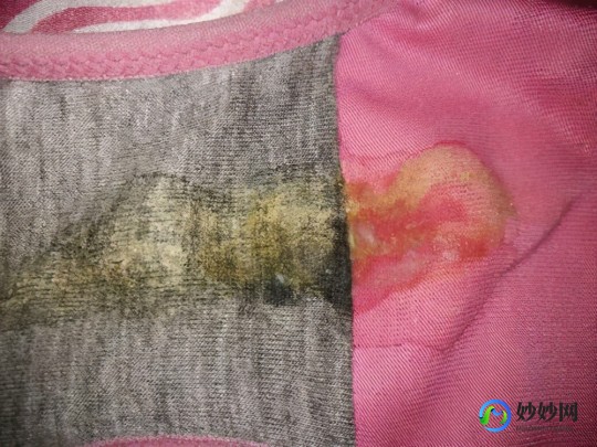 黄到下面流透明液体,白带黄后来透明怎么回事