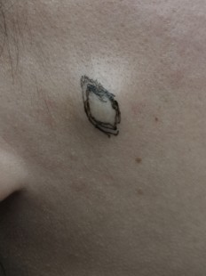 皮下脓肿,皮下囊肿硬块