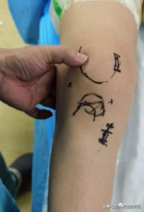 髌骨脱位,怎样判断髌骨脱位