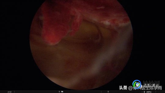 髌骨脱位,怎样判断髌骨脱位