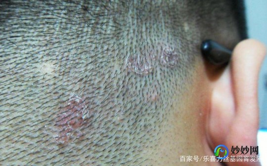 头上长疙瘩怎么回事,头上长肉疙瘩是什么