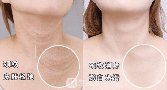 颈纹,脖子上的颈纹怎么形成的