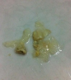 白带多有腥臭味是什么原因引起的,白带多腥味是怎么回事