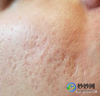 脸上的痘坑怎么去掉,脸上很多痘坑怎么处理