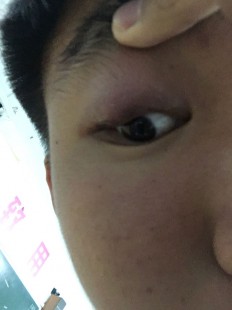 眼睛肿胀疼痛怎么回事,眼睛疼肿胀怎么回事