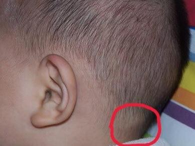 脖子上有肿块,脖子上有肿块是怎么回事