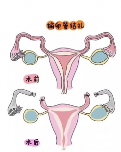 结扎后试管不成功率高吗_输卵管结扎后试管成功率高吗