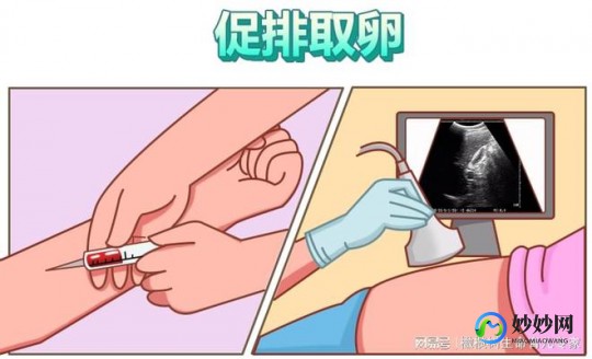 无精症试管婴儿流程费用-无精症试管婴儿流程步骤