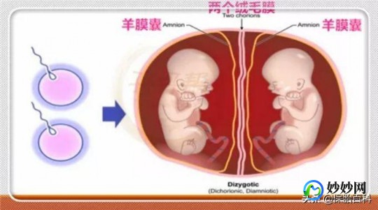高龄双胎试管妈妈—试管高龄移植双胎好吗