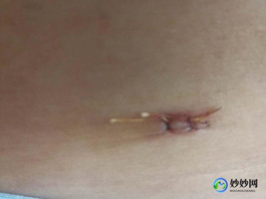 多年不孕需要做腹腔镜吗,多年不孕有必要做宫腔镜吗