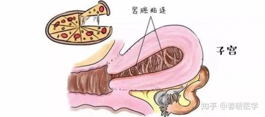 宫腔黏连多年不孕(宫腔粘连好几年不孕)