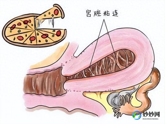宫腔黏连多年不孕(宫腔粘连好几年不孕)