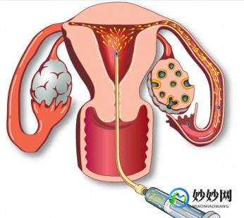 重庆有试管助孕吗医生重庆试管助孕