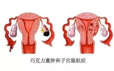 没有子宫胸也不发育(先天性没有子宫胸部也没有发育)